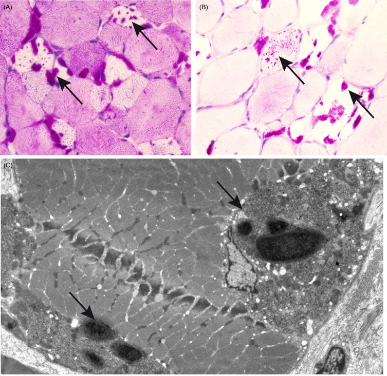 Pompe disease muscle biopsy: PAS-positive glycogen vacuoles