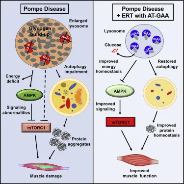 Pompe disease pathophysiology and ERT mechanism