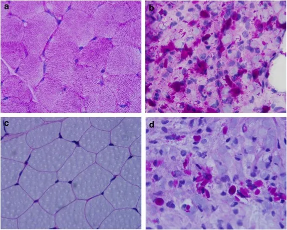 GSD IV: Polyglucosan bodies in liver, muscle, nerve