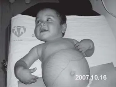 Child with Von Gierke disease