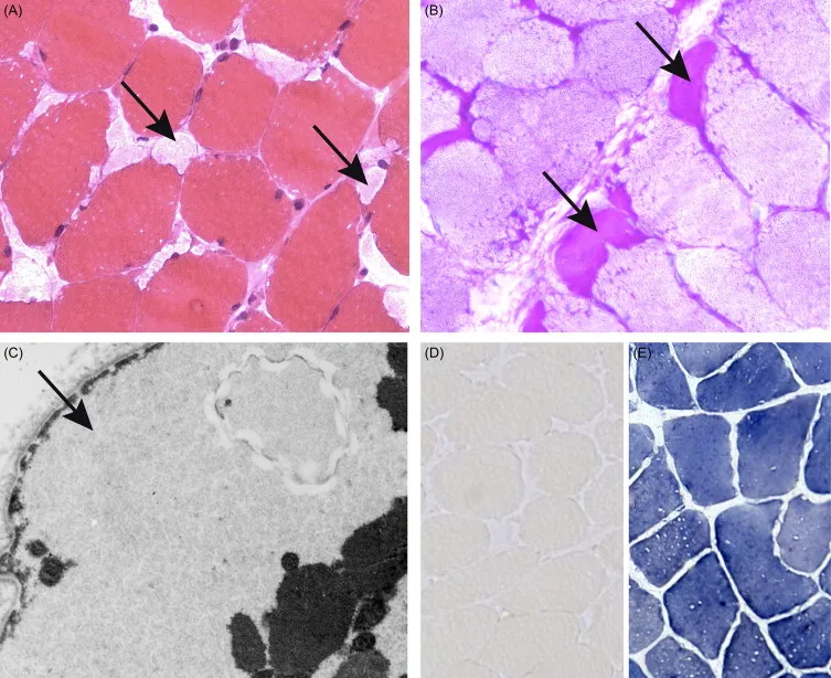 McArdle Disease Muscle Biopsy: Glycogen Accumulation
