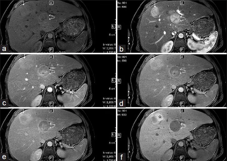 MRI of hepatic adenoma in Glycogen Storage Disease Type I