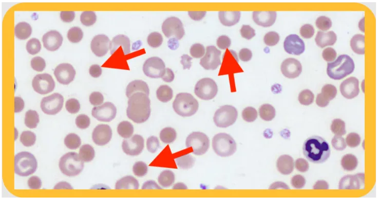 Echinocytes in pyruvate kinase deficiency blood smear