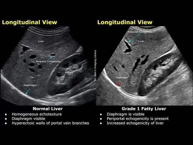 Normal vs Grade 1 Fatty Liver Ultrasound