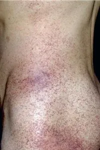 Angiokeratomas on torso in Fabry disease