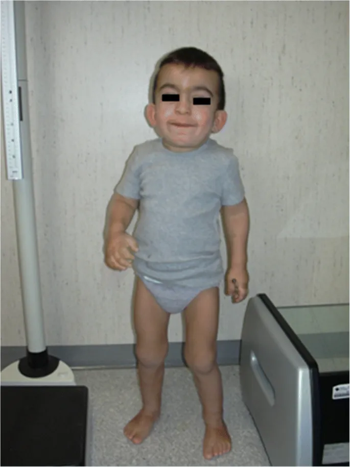Child with Hurler syndrome showing coarse facial features