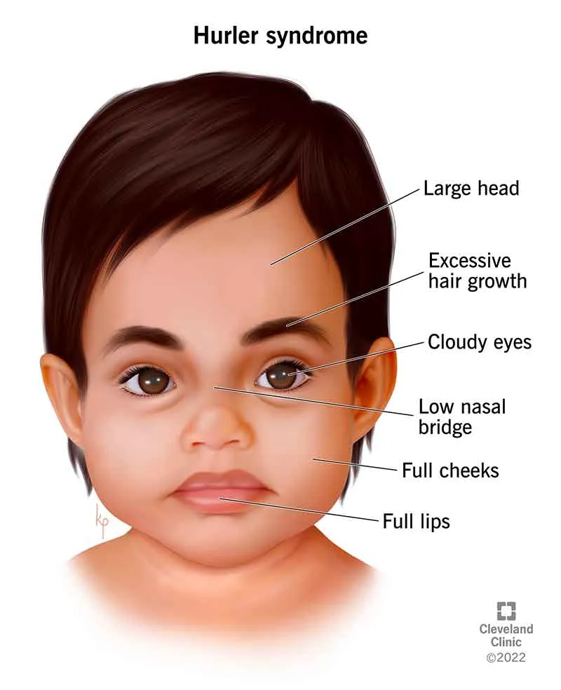 Hurler syndrome facial features