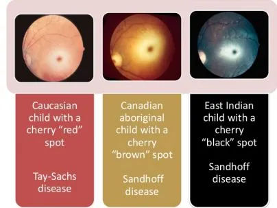 Fundoscopy: Cherry-red, brown, and black spots in LSDs