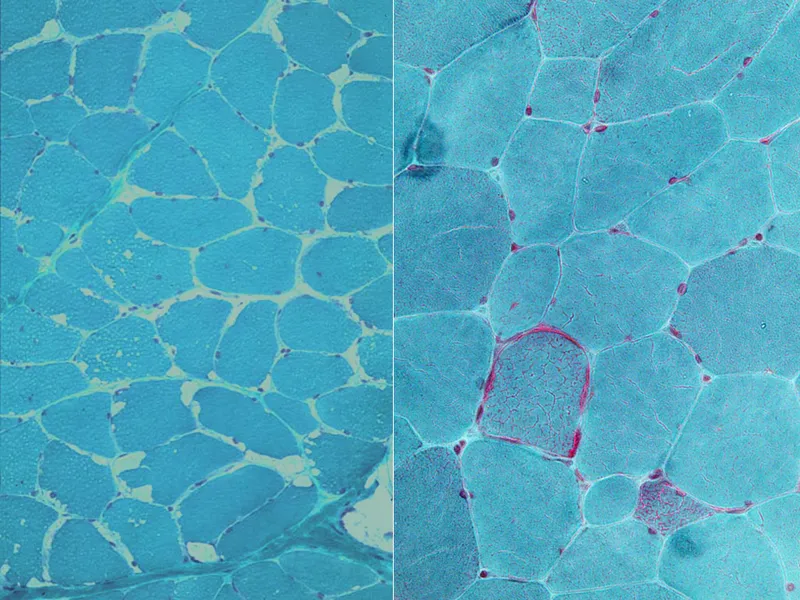 Ragged Red Fibers in Mitochondrial Myopathy