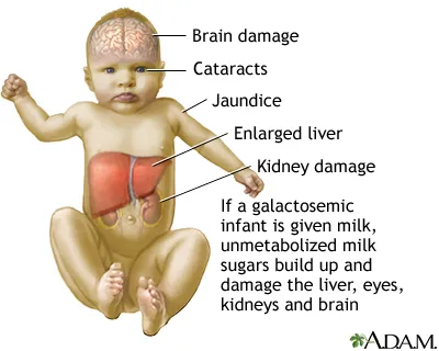 Galactosemia: Symptoms and affected organs in infants