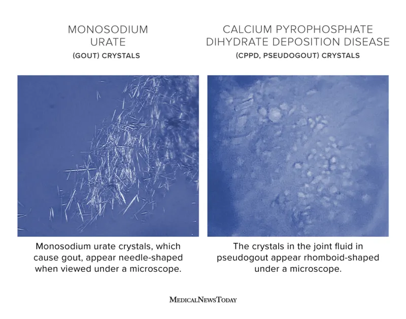 Monosodium urate vs CPPD crystals
