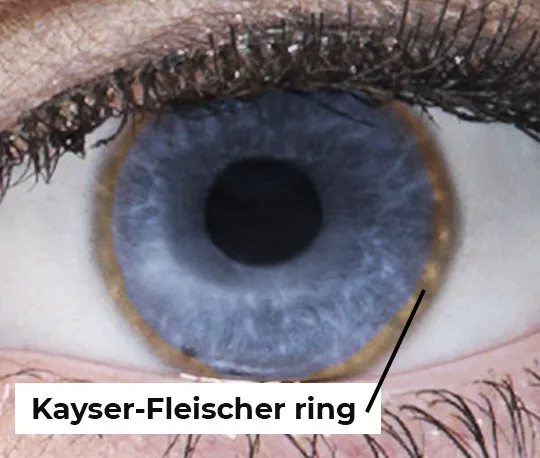 Kayser-Fleischer ring