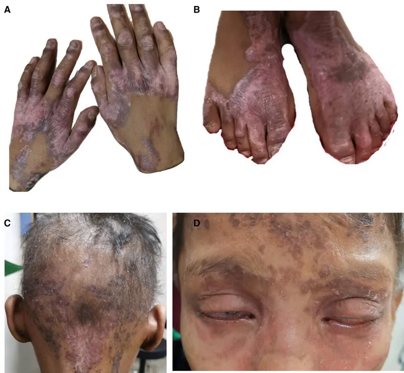 Acrodermatitis Enteropathica skin lesions