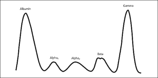 SPEP patterns in nephrotic syndrome, cirrhosis, myeloma