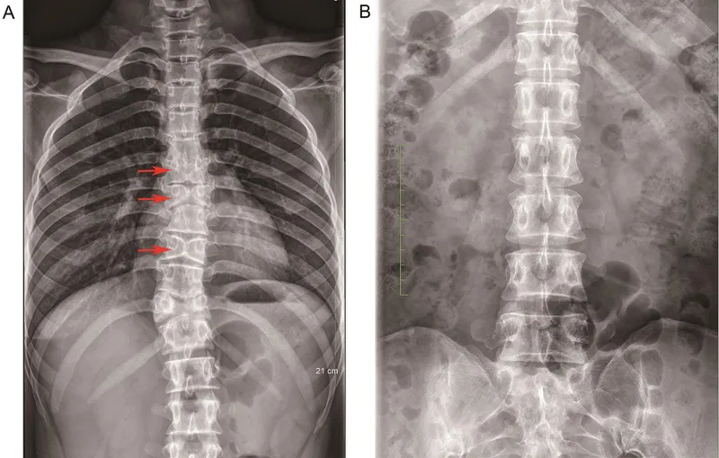 X-ray showing butterfly vertebrae in Alagille syndrome