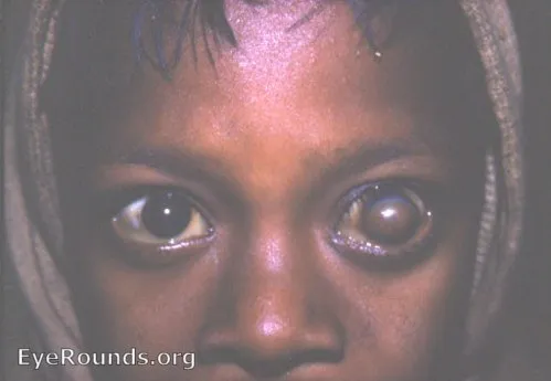 Vitamin A deficiency: Keratomalacia and Bitot's spots