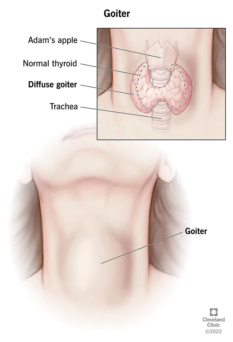 Goiter: Normal vs. Enlarged Thyroid Gland