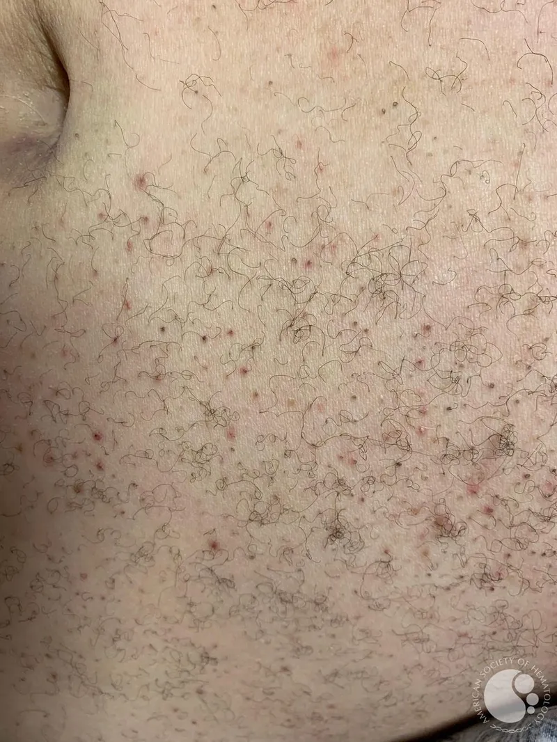 Scurvy: Corkscrew hairs and perifollicular hemorrhage