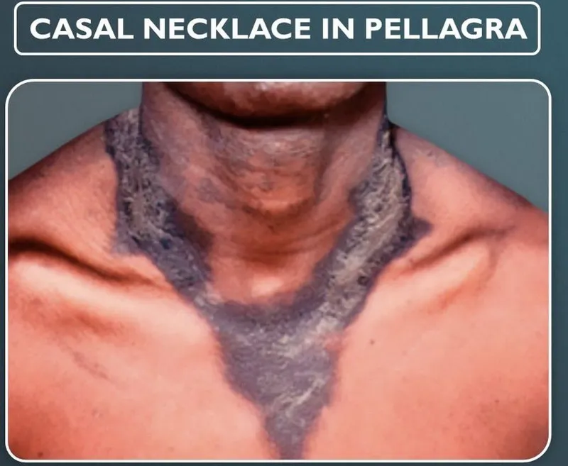 Casal's necklace rash in pellagra