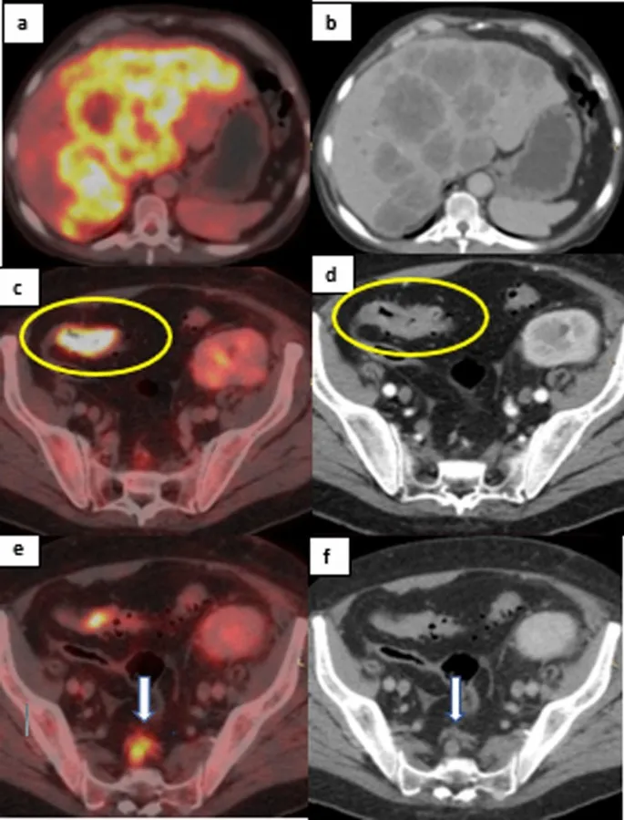 FDG-PET/CT in Fever of Unknown Origin