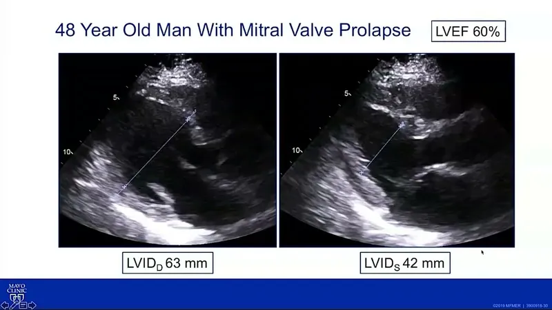 Echocardiogram of mitral valve prolapse with measurements