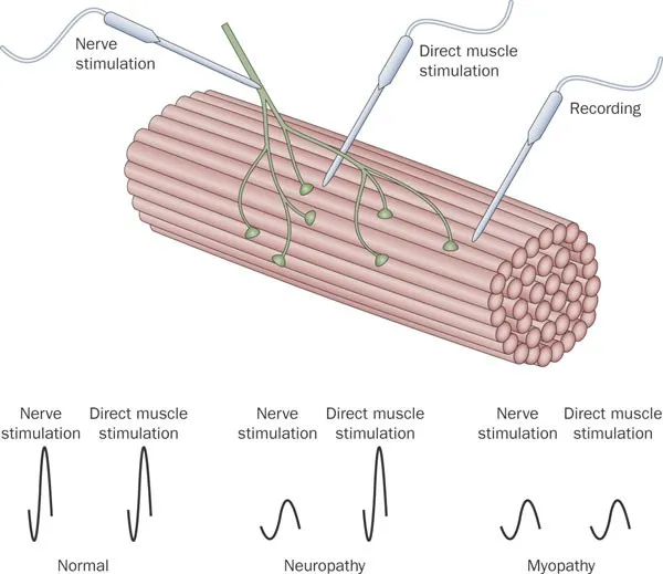 EMG patterns in normal, neuropathy, and myopathy