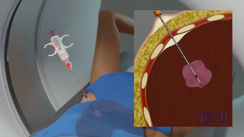 CT-guided core needle biopsy of a liver lesion