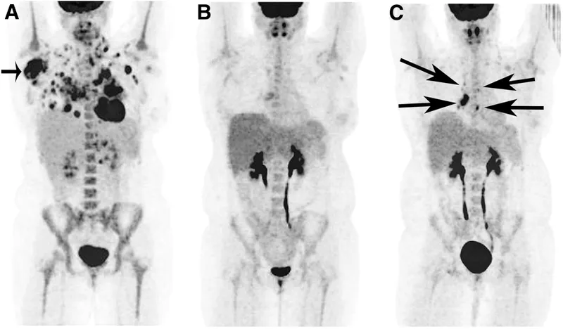 PET scans: Lymphoma with metastases vs. remission