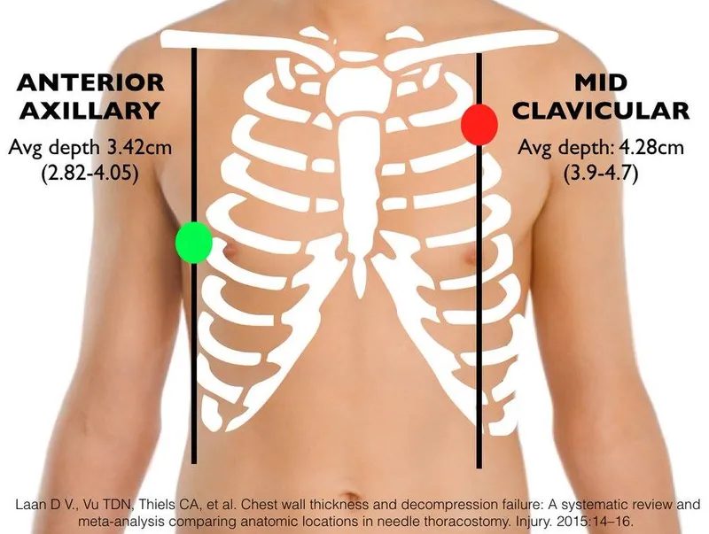 Needle Thoracostomy Landmarks & Depths