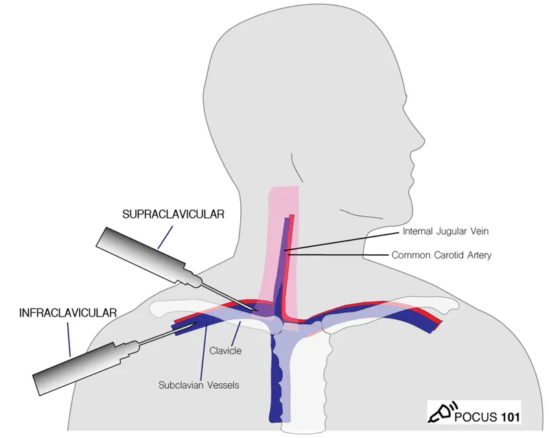 Central Line Insertion Landmarks: IJV, Subclavian, Femoral