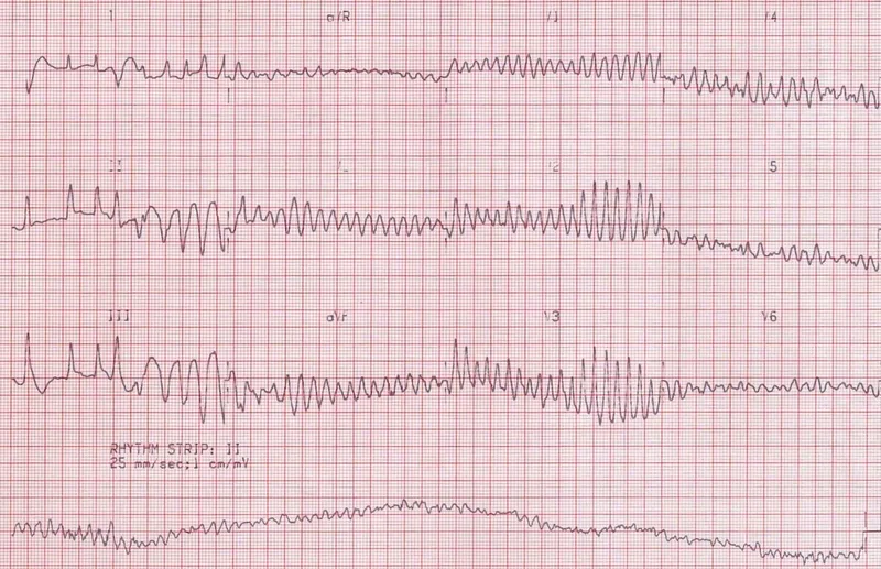 ECG: Ventricular Fibrillation to Asystole