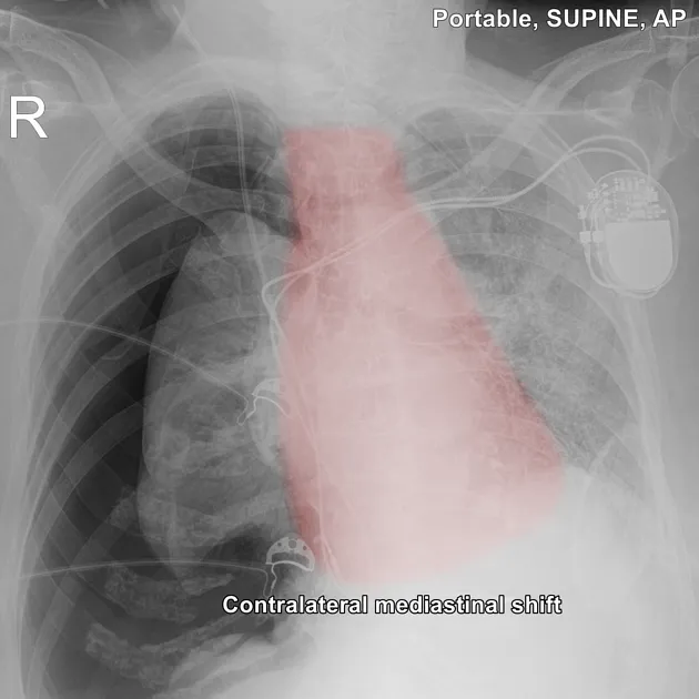 Chest X-ray: Tension Pneumothorax with Mediastinal Shift