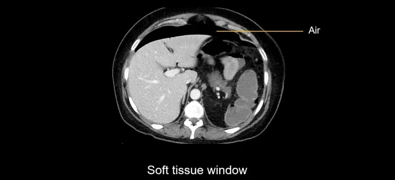 CT Abdomen: Free Air Indicating Visceral Perforation