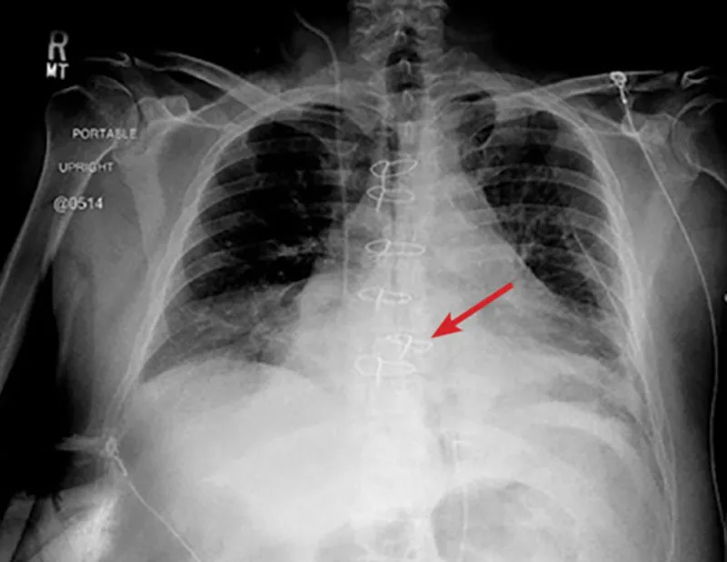 Sternal Dehiscence on X-ray with Sternal Wires