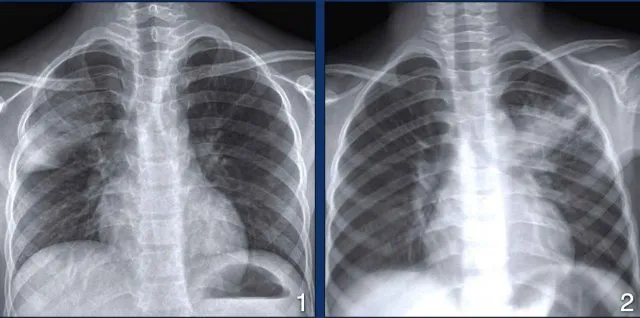 Chest X-rays showing Ghon complex and apical cavitation