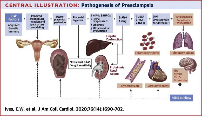 Pathogenesis of Preeclampsia