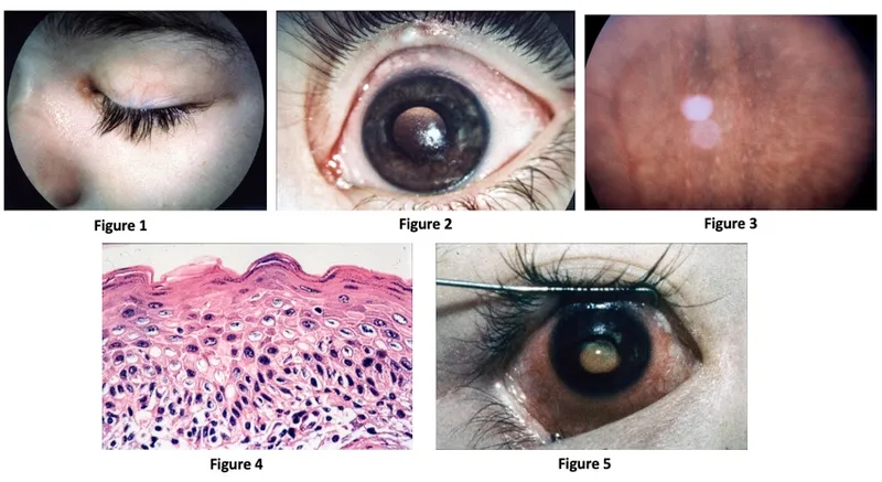 Bitot's spots and xerophthalmia signs