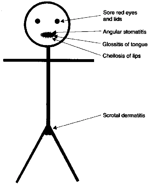 Angular stomatitis in Riboflavin deficiency