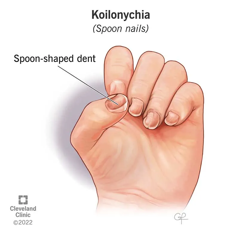 Koilonychia (Spoon nails)