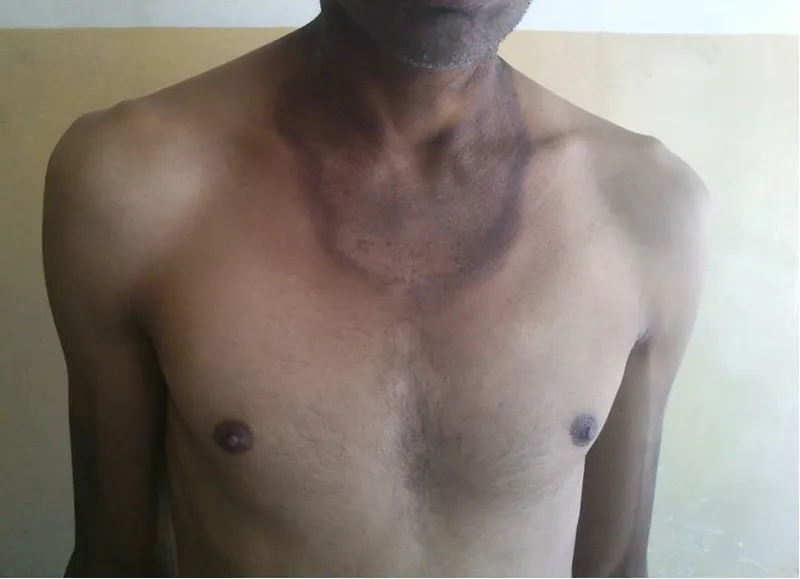 Pellagra dermatitis (Casal's necklace)