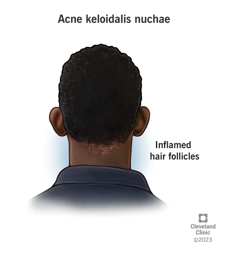 Acne Keloidalis Nuchae: Inflamed Hair Follicles