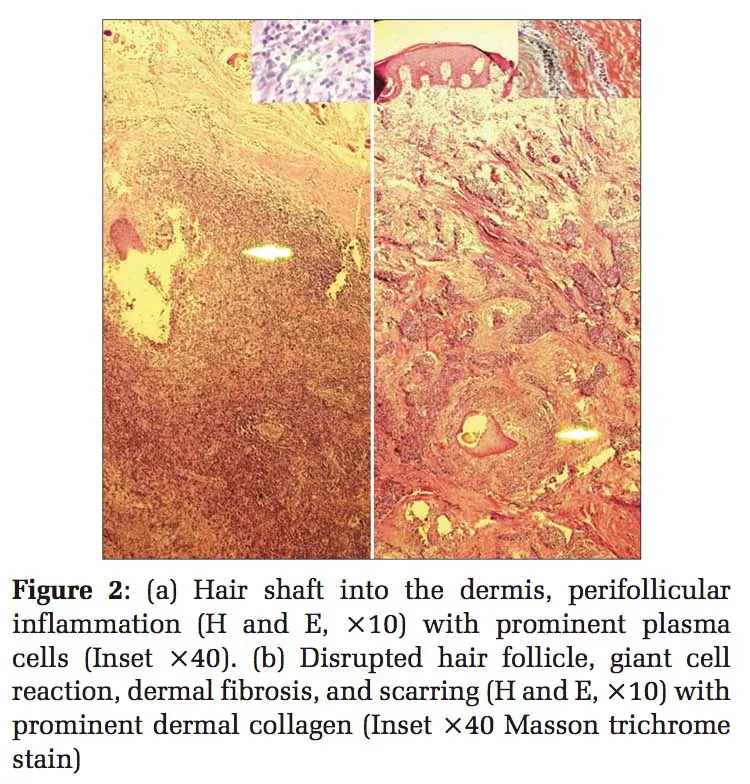 Acne Keloidalis Nuchae Histopathology