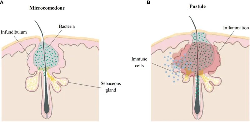 Acne Vulgaris Pathophysiology: Microcomedone to Pustule