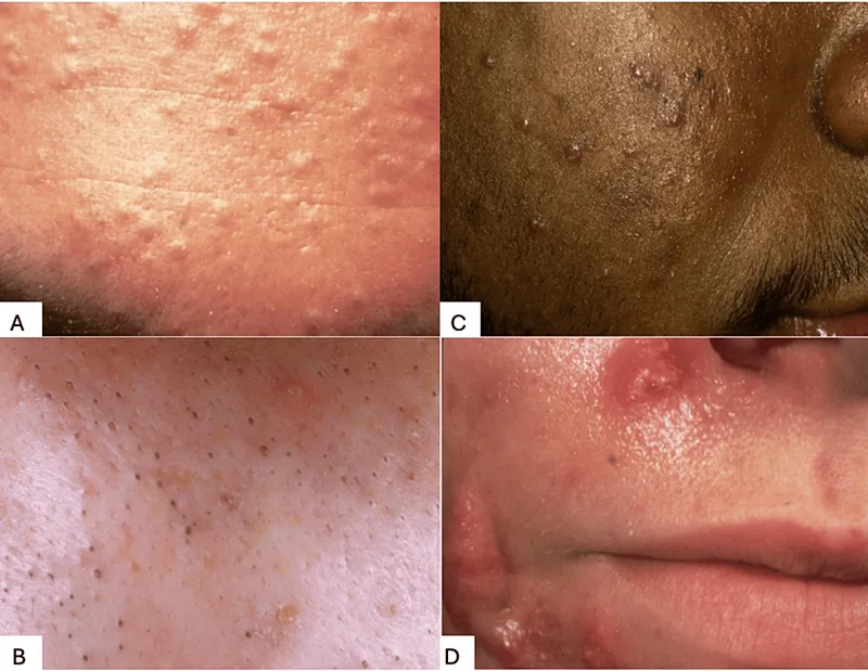 Neonatal vs infantile acne