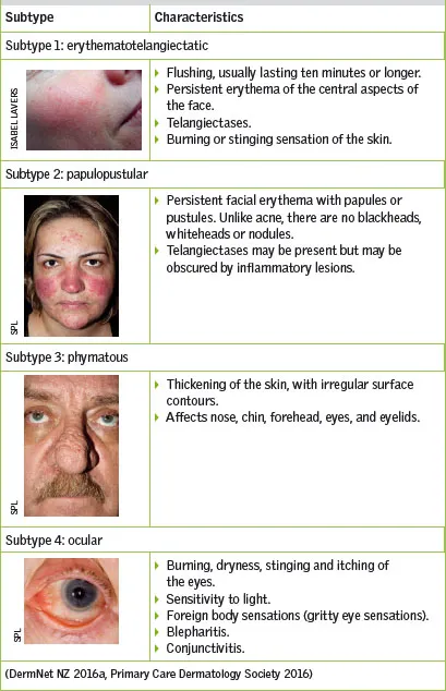 Rosacea Subtypes and Characteristics
