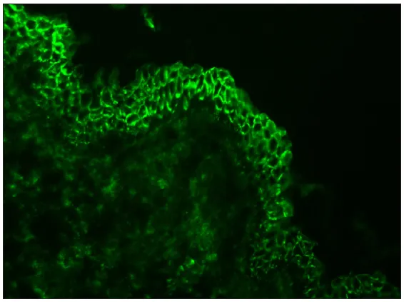 Direct immunofluorescence showing chicken wire pattern