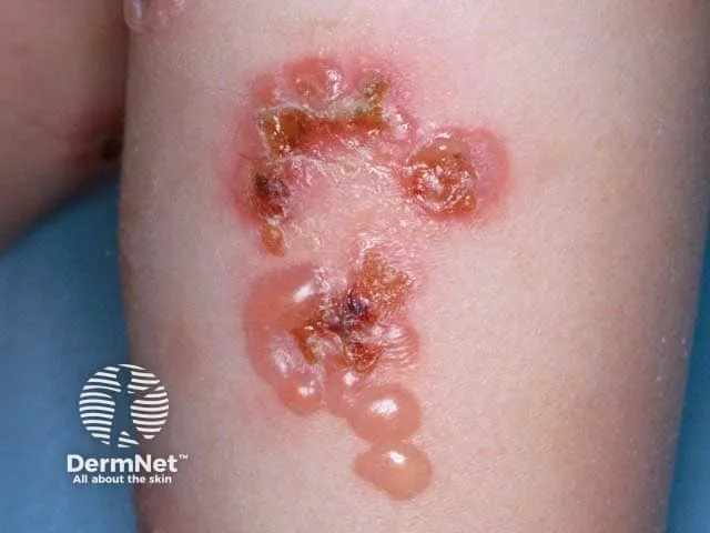 Linear IgA Bullous Dermatosis "string of pearls"