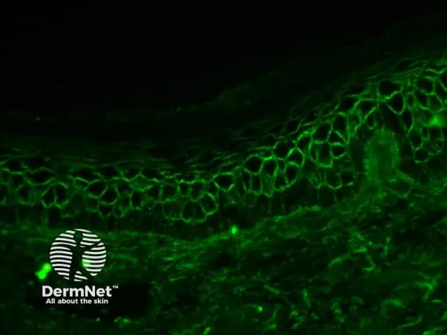 Direct immunofluorescence showing chicken wire pattern