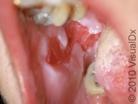 Pemphigus vulgaris oral lesions