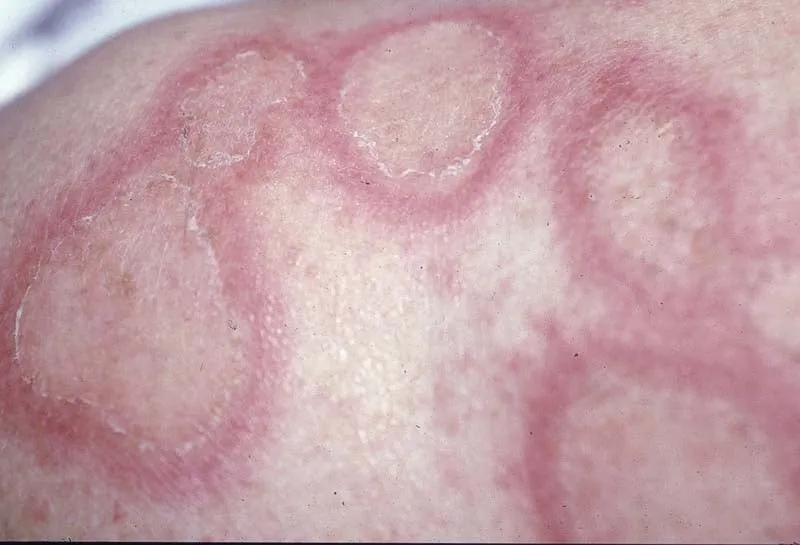 Annular lesions of subacute cutaneous lupus erythematosus